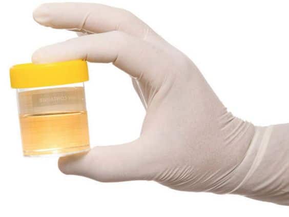 Urine Tests