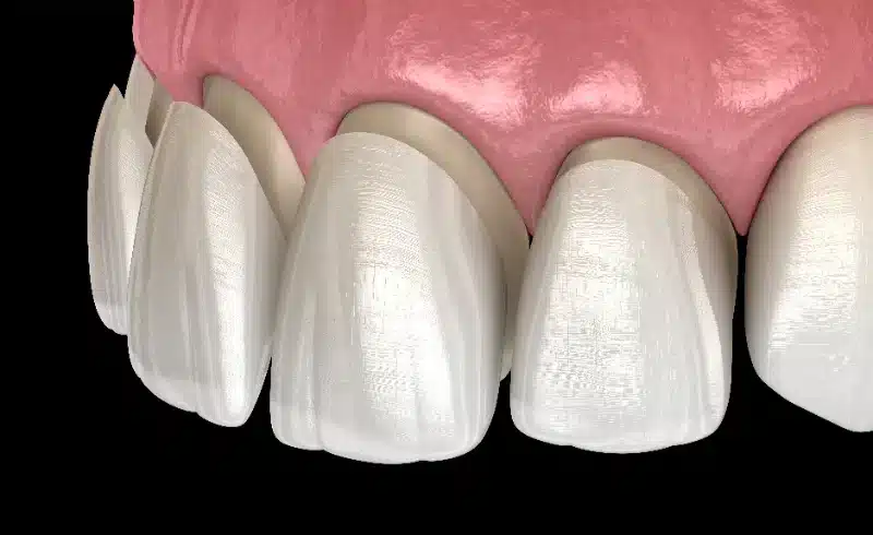 Veneers dubai