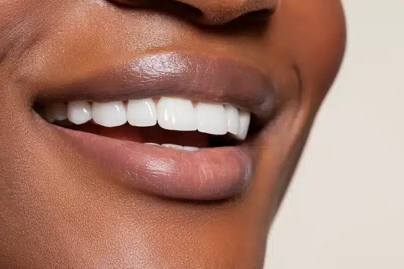 What Are Veneers?