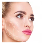 Thread face lift