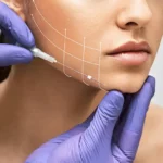 Non Surgical Face Lift dubai