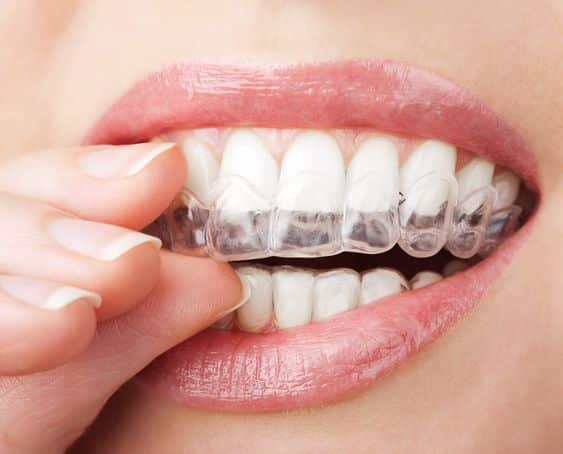 The powerful journey toward straight and invisible Clear Aligner