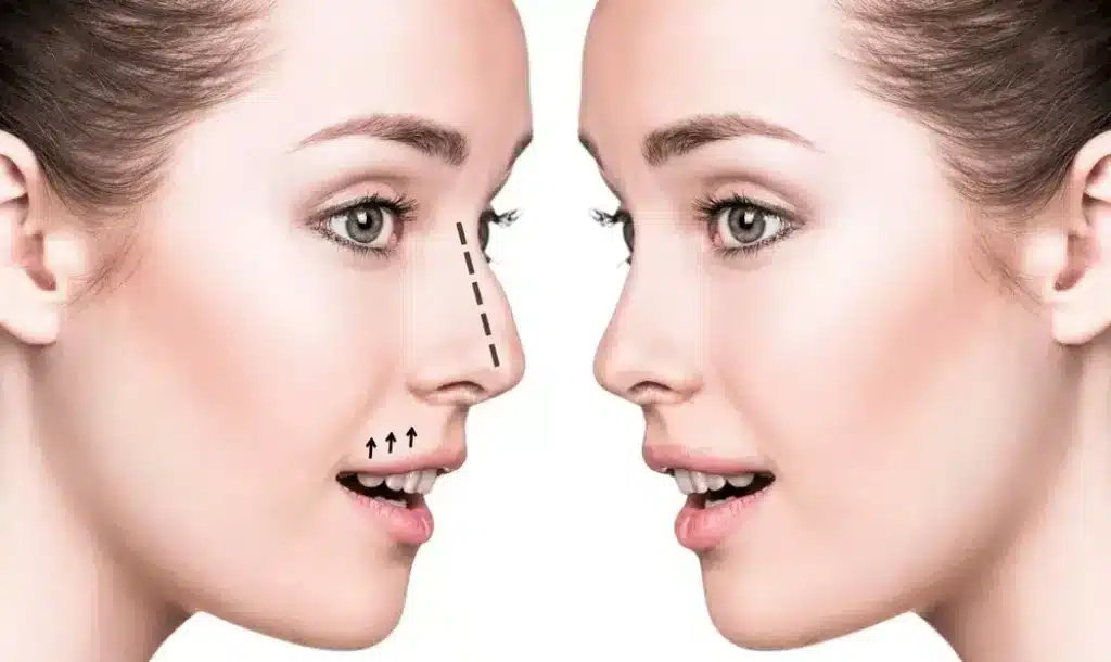 Redefine your beauty with personalized nose filler injections