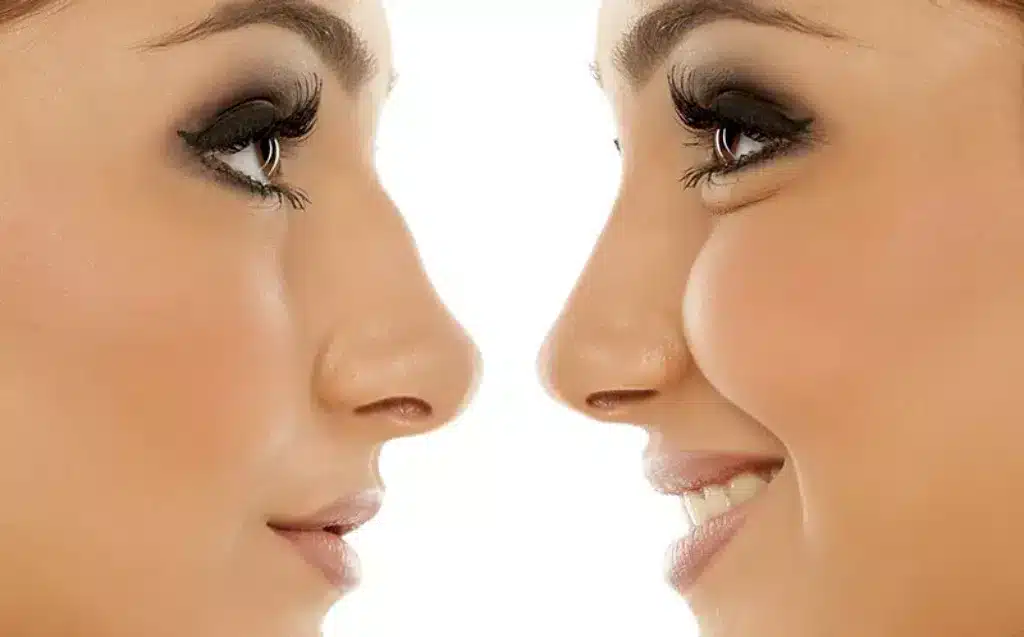 Achieve balance and harmony with our top-rated nose fillers