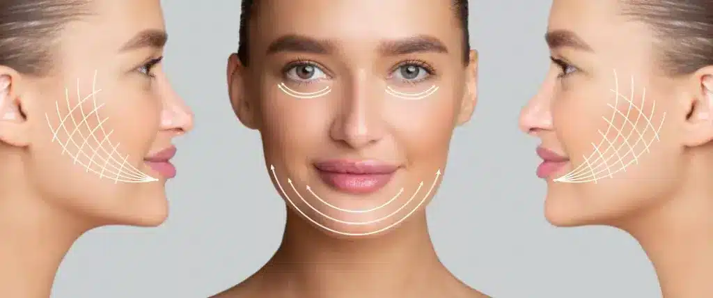 Types Of Thread Lifts and facelift dubai