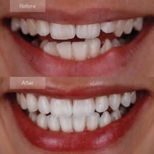 Invisalign success story - Progress in correcting lower front teeth misalignment.