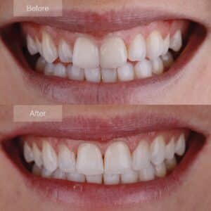 Before and after Invisalign - Significant improvement in lower incisor alignment.