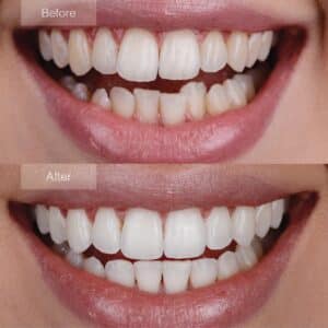 Enhanced smile aesthetics - Invisalign treatment for upper lateral molars.