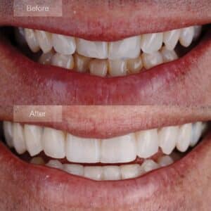 Invisalign journey - Successful correction of lower lateral incisor misalignment.