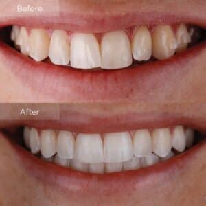 Before and after Invisalign - Notable changes in lower lateral molar positioning.