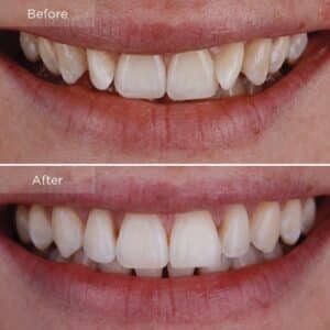 Achieving dental harmony - Invisalign treatment for upper and lower canines.