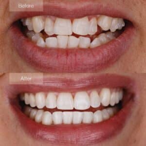 Transformation with Invisalign - Enhanced positioning of upper molars before and after.