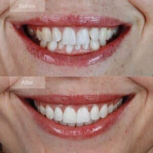 Smile makeover with Invisalign - Positive changes in lower molar positioning.