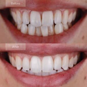 Invisalign results - Clear improvement in upper lateral incisor alignment.