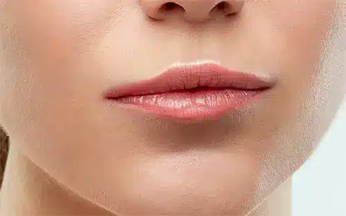 Expert lip augmentation for a confident, beautiful smile