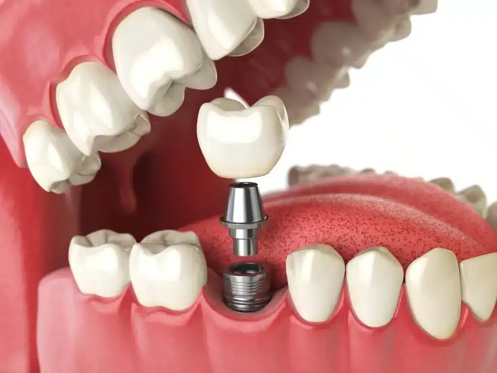 Endosteal Implants (Most Common