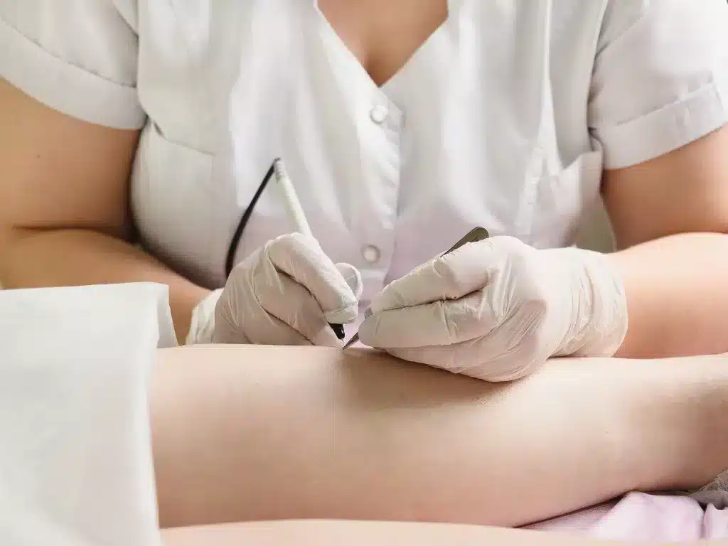 Pros and Cons of Electrolysis Hair Removal